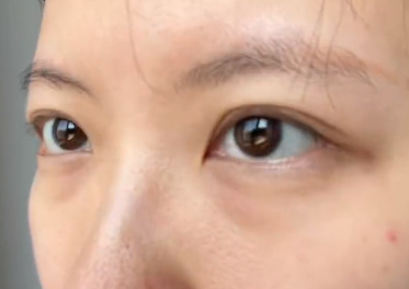 去眼袋手术