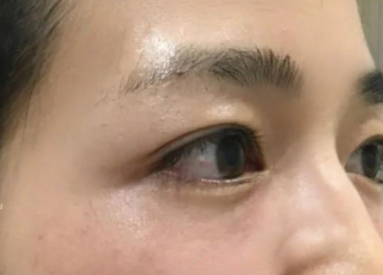 去眼袋手术