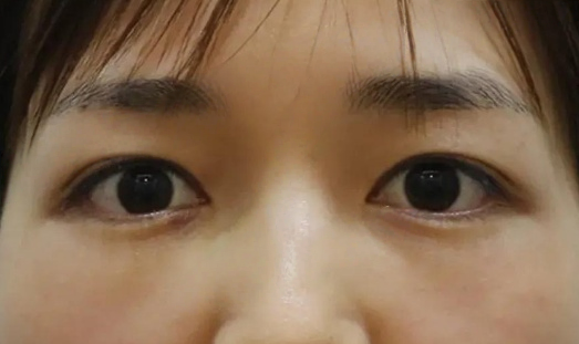 去眼袋手术