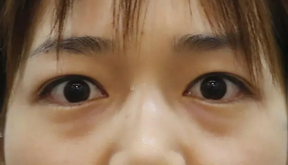去眼袋手术