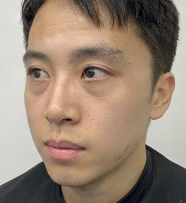 去眼袋手术