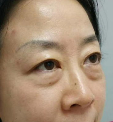 去眼袋手术