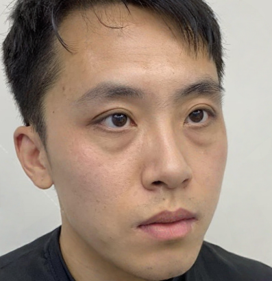 去眼袋手术