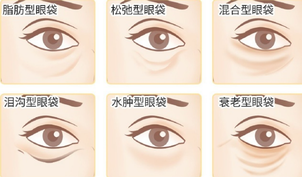 去眼袋手术