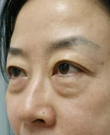 去眼袋手术