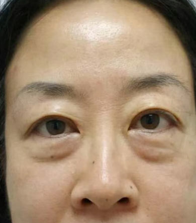 去眼袋手术