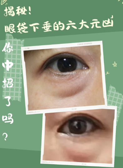 去眼袋手术