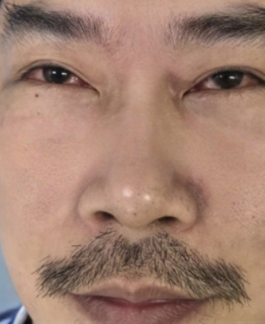 去眼袋手术