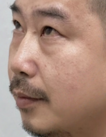 去眼袋手术