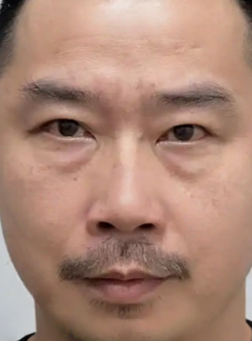 去眼袋手术