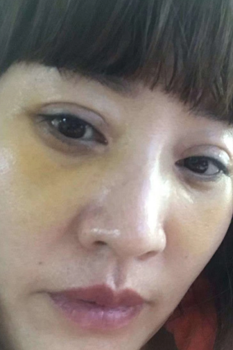 去眼袋手术