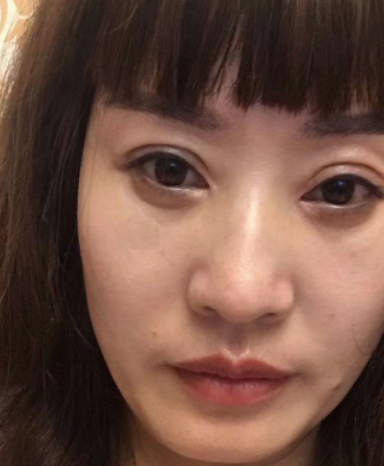 去眼袋手术