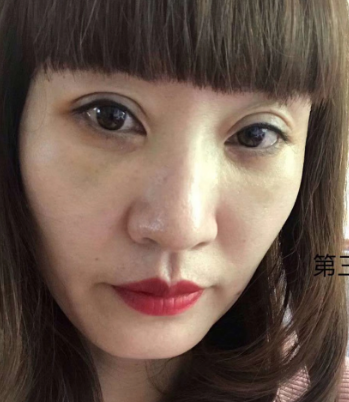 去眼袋手术