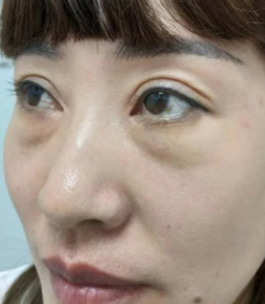去眼袋手术