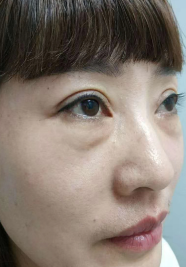 去眼袋手术
