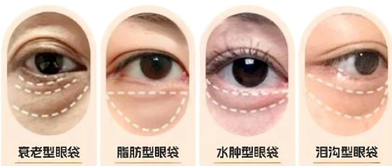 去眼袋手术