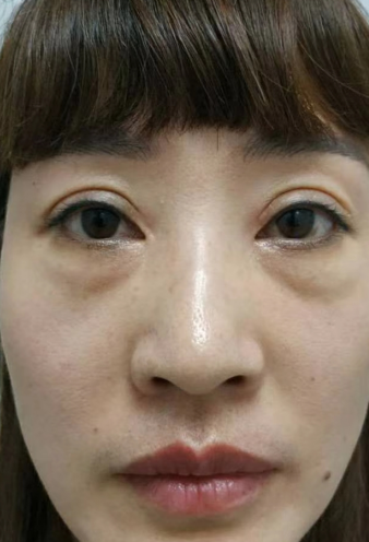 去眼袋手术