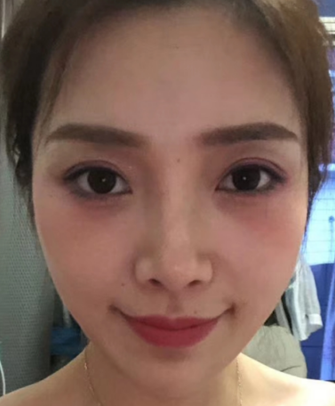 去眼袋手术