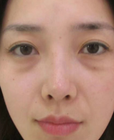 去眼袋手术