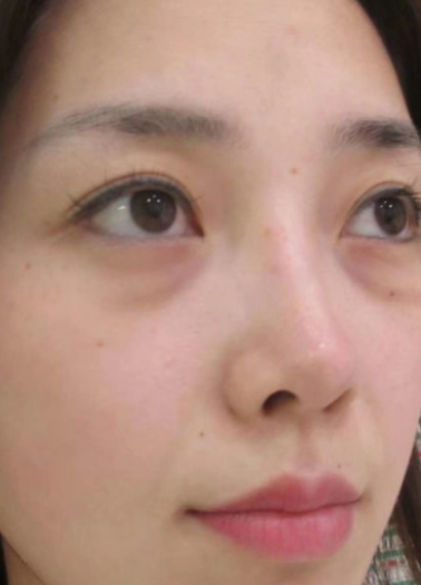 去眼袋手术