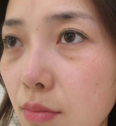 去眼袋手术