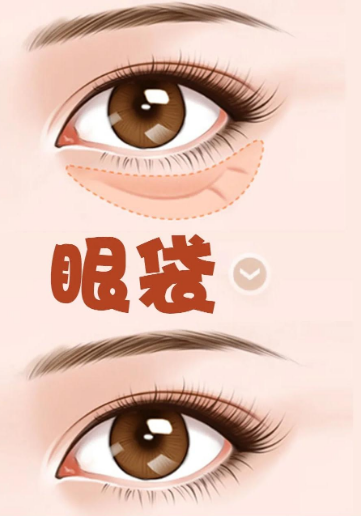 去眼袋手术