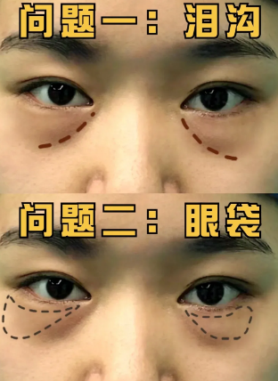 眼袋