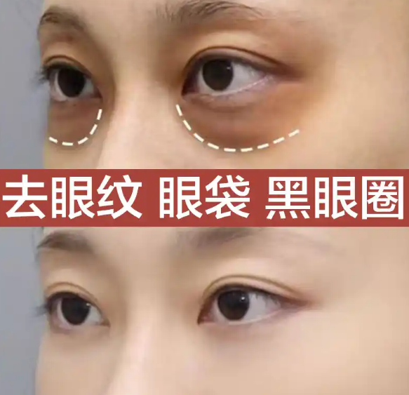 眼袋