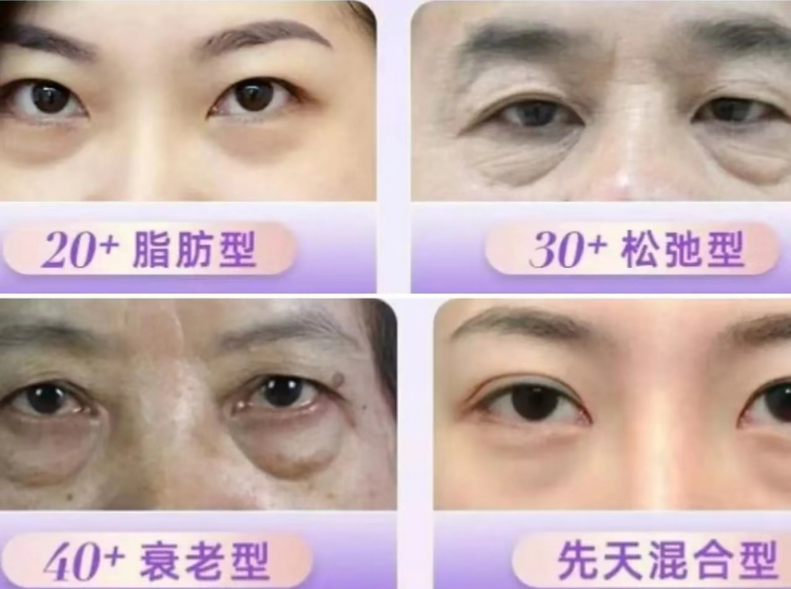眼袋