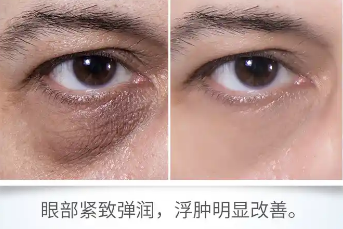 眼袋