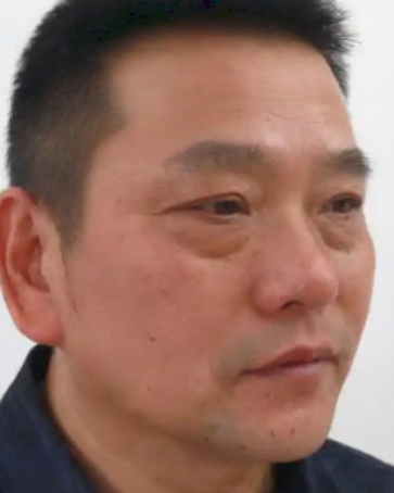 去眼袋手术
