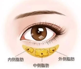去眼袋手术