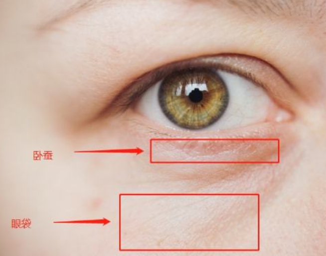 去眼袋手术