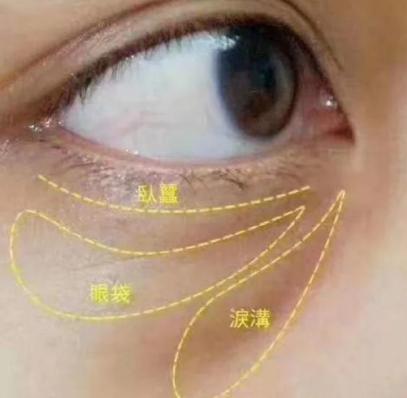 去眼袋手术