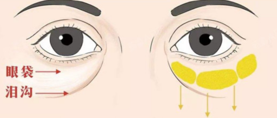 去眼袋手术