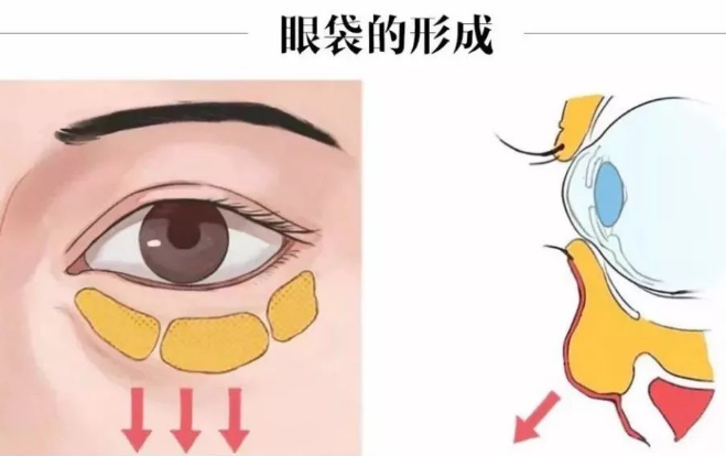 去眼袋手术
