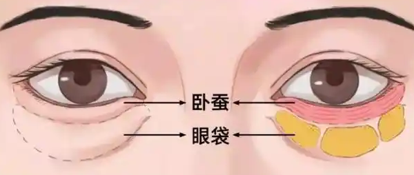 去眼袋手术