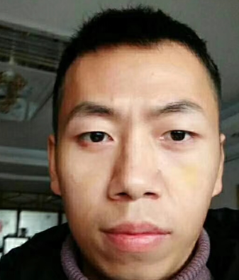 去眼袋手术