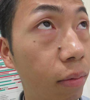 去眼袋手术