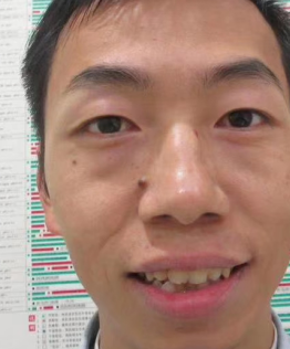 去眼袋手术