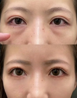 眼袋