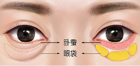 眼袋
