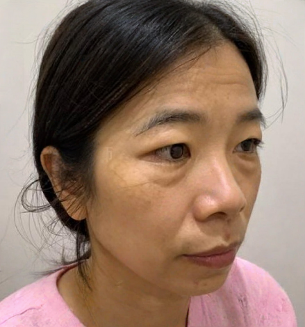 去眼袋手术