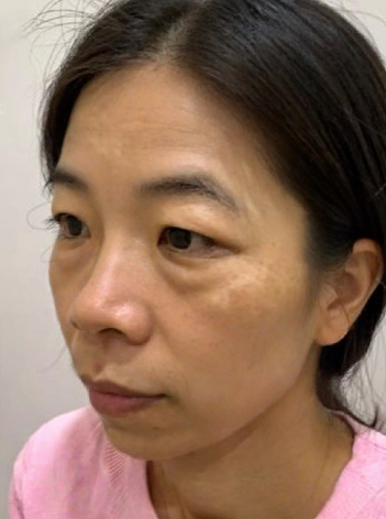 去眼袋手术