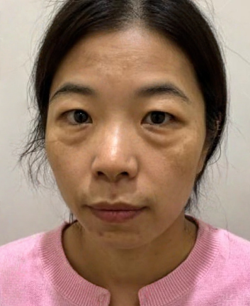 去眼袋手术