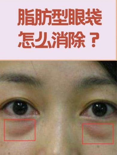去眼袋手术