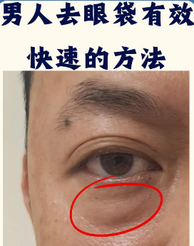 眼袋