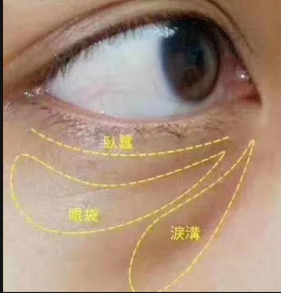 去眼袋手术