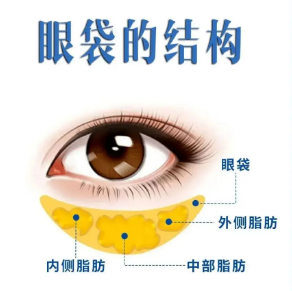 去眼袋手术