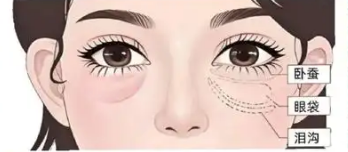 去眼袋手术